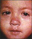 This is a photo from the Centers for Disease Control in Atlanta that shows a child with watery eyes and speckled face, both symptoms of the measles.